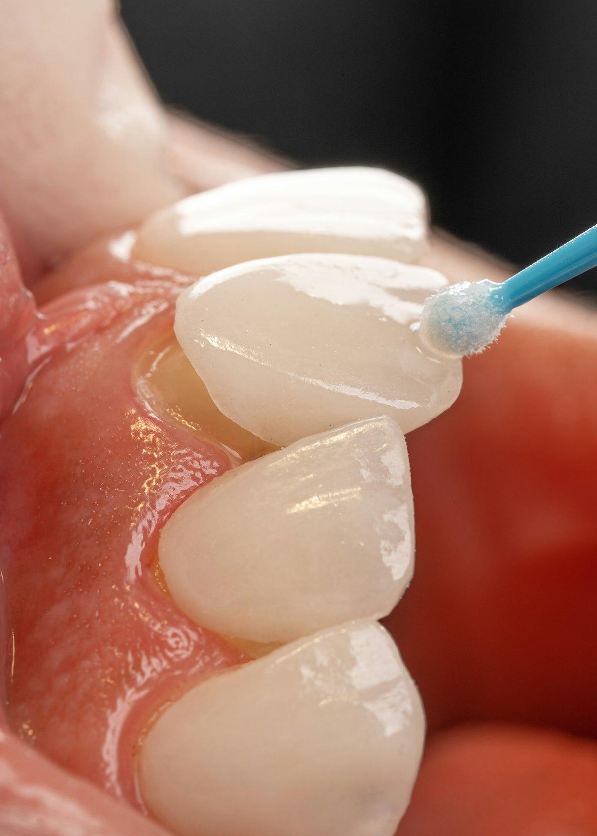 Dentisterie esthétique